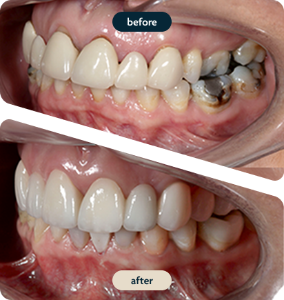 Before and after composite white filling replacement