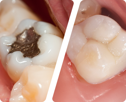 Before and after composite white filling replacement